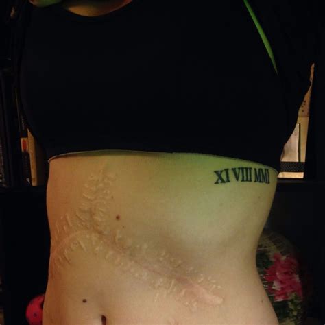 Xi Viii Mmi Transplant Date Near Scar Tattoo Date Scar Tattoo Tattoos
