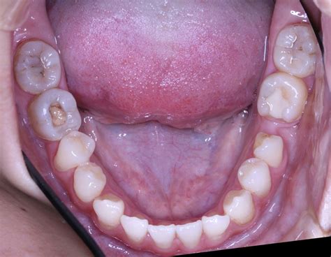 【抜歯 虫歯】矯正治療中に虫歯を放置すると場合によっては抜歯となる