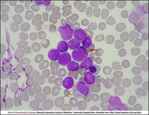 T Lymphoblastic Leukaemialymphoma Cell Atlas Of Haematological Cytology