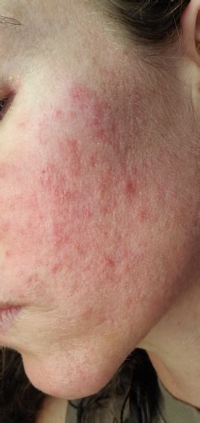 Cheek Of Womans Face With Acne And Redness Rosacea Outbreak Stock Photo