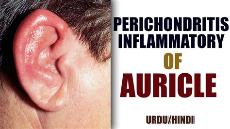 Perichondritis Inflammatory Diseases Of The Auricle Youtube