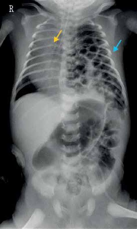 Abdominal Chest X Ray Showing Left Diaphragmatic Hernia With The