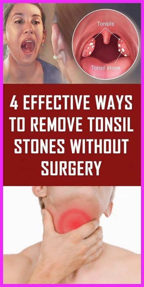 Your Tonsils Are Made Up Of Crevices Tunnels And Pits Called Tonsil