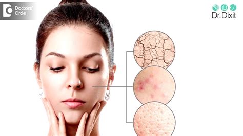 Is Oily Skin Genetic Is It More Prone To Acne Dr Rasya Dixit