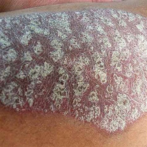 Psoriasis Skin Condition Explained And Several Effective