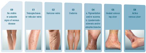 Location Of Venous Stasis Ulcers Leg Ulcers Wound Care Disease