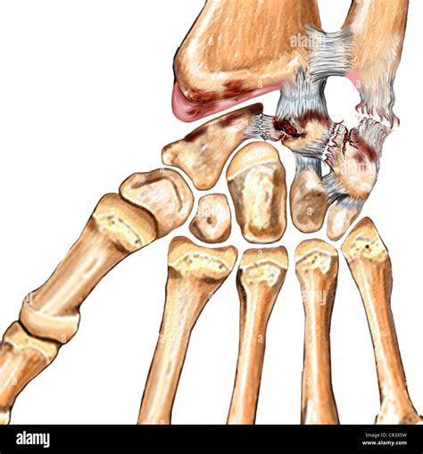 This Medical Illustration Features The Torn Ulnar Collateral Ligament