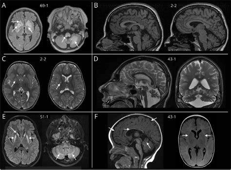 Examples Of Brain Mri Changes Detected In Patients With Download
