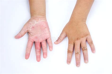 Las Manos Secas Cáscara Dermatitis De Contacto Infecciones Por