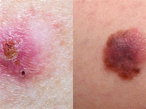 Bevægelse Bar Radioaktivitet 3 Types Of Skin Cancer Skræmmende Pompeji
