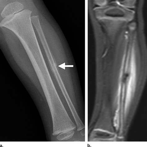 Toddlers Fracture Subacute Fibular Stress Fracture In A 3 Year Old