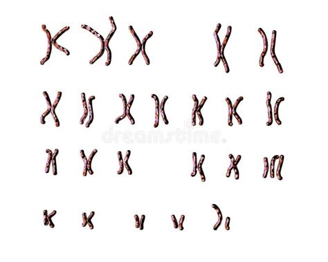 Karyotype D Edwards Syndrome Illustration Stock Illustration Du