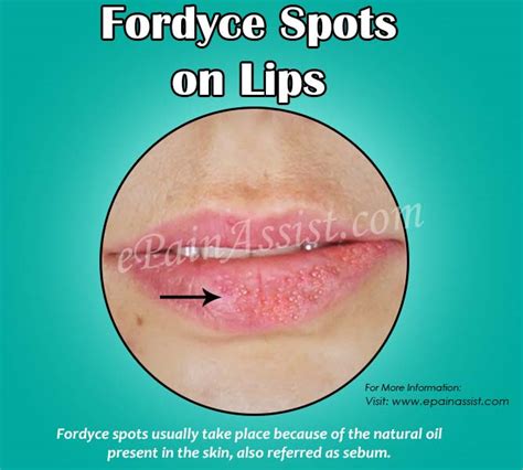 What Do Fordyce Spots Look Like On Lips
