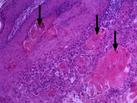 A keratin pearl is a keratinized structure found in regions where abnormal squamous cells form concentric layers. "keratin pearls,"--actinic keratosis | Pearls, Keratin, Kaplan