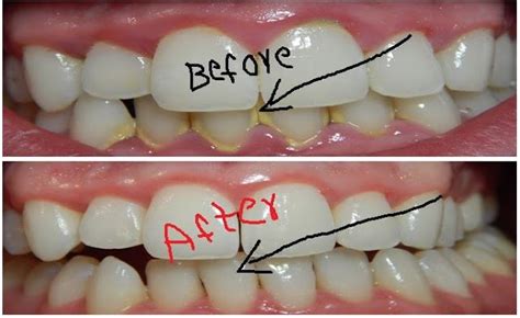 How To Remove Dental Plaque In 5 Minutes Naturally Without Going To