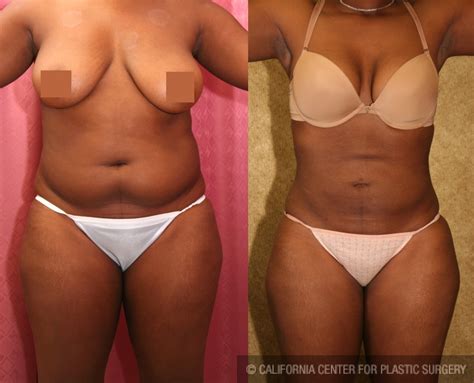 Patient Liposuction Abdomen Medium Before And After Photos