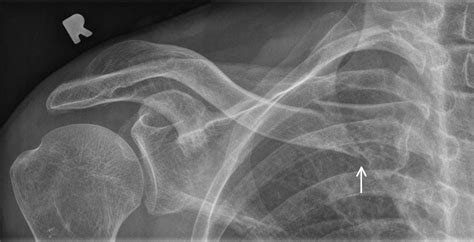 Clavicle Fractures Allman And Neer Classification Journal Of