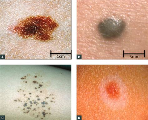Racgp Management Of Pigmented Skin Lesions In Childhood And Adolescence