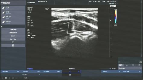 Vietnamese Medic Ultrasound Case 577 Tos Thoracic Outlet Syndrome