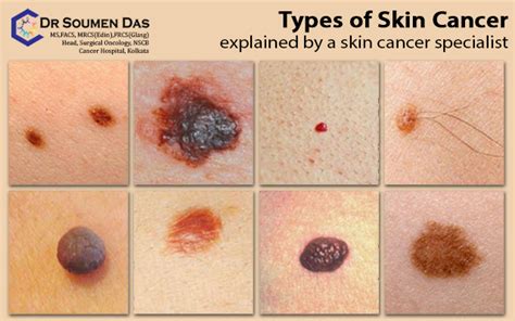 Types Of Skin Cancer Explained By A Skin Cancer Speci