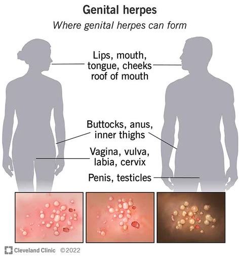 Genital Herpes Diagnosis