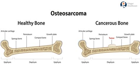 Bone Cancer Symptoms Causes Diagnosis Types And Treatment Options