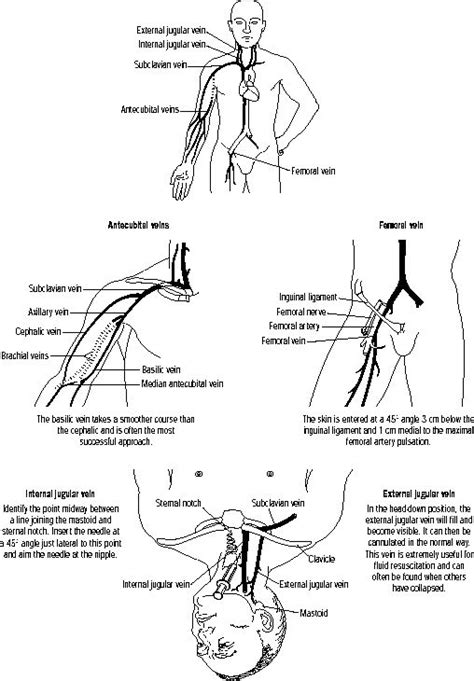 72 Best Images About Nursing Catheters On Pinterest Urinary