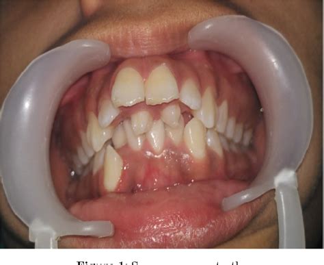 Figure 1 From Management Of Maxillary Anterior Supernumerary Teeth