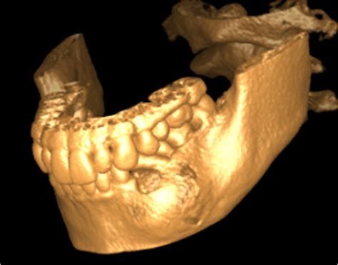 Cysts Of The Jaw Dr Khaled Amin Tarboush Dds Ms Cags