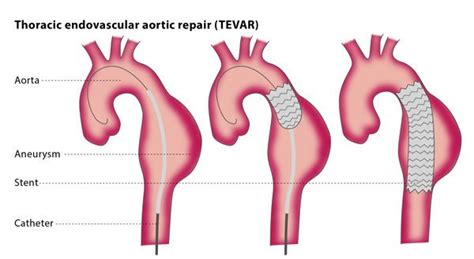 Thoracic Endovascular Aortic Repair Tevar Interventional Radiology