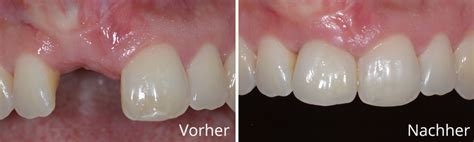 Zahnarzt Frankfurt Implantologie Parodontologie Wurzelkanalbehandlung