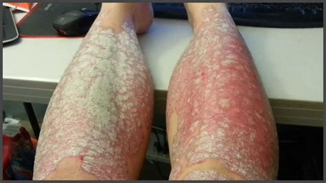 Psoriasis On Lower Legs Pictures Psoriasis Expert