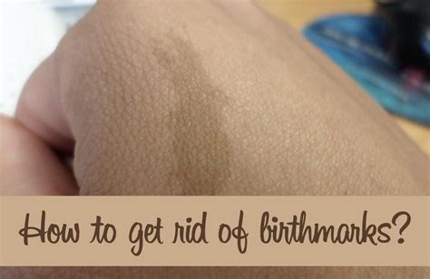 Birthmark Removal How To Get Rid Of Birthmarks Birthmark How To