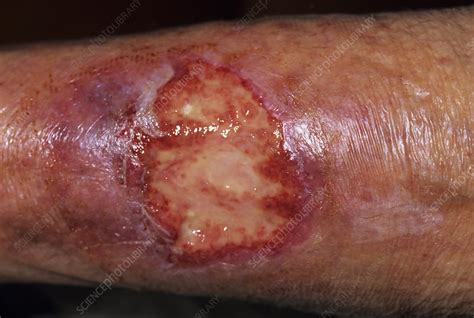 Infected Wound Stock Image M3301176 Science Photo Library