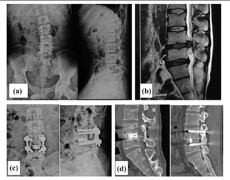 Figure 1 From Comparative Analysis Of Transforaminal Lumbar Interbody Fusion Versus