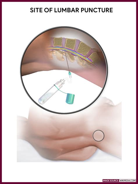 Lumbar Puncture Spinal Tap Nursing Responsibilities Nurseslabs