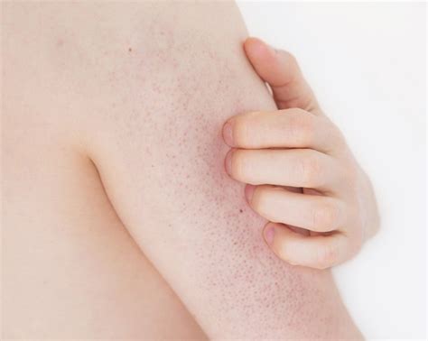 Skin Rash Causes Of Red Spots And Bumps With Pictures Allure