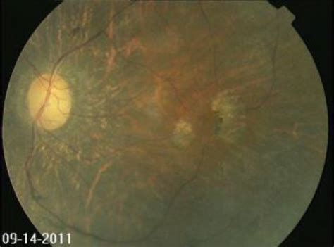 Fundus Photograph Of Eye With Advanced Retinitis Pigmentosa Note