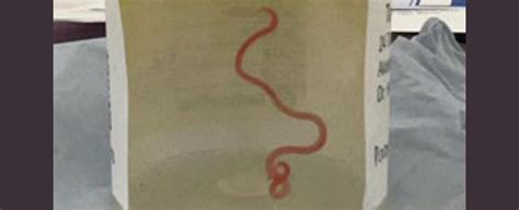 Surgeons Pull A Live Roundworm From A Womans Brain In Horrific First