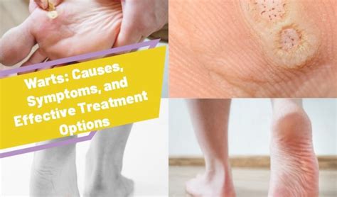 Warts Causes Symptoms And Effective Treatment Options A To Z