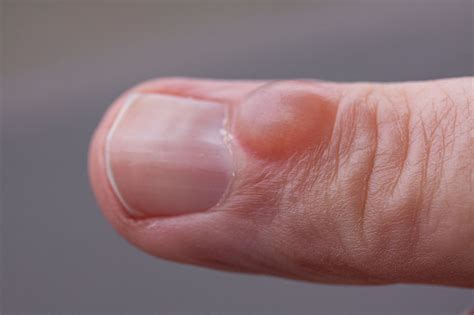 Mucous Cysts Finger Bumps
