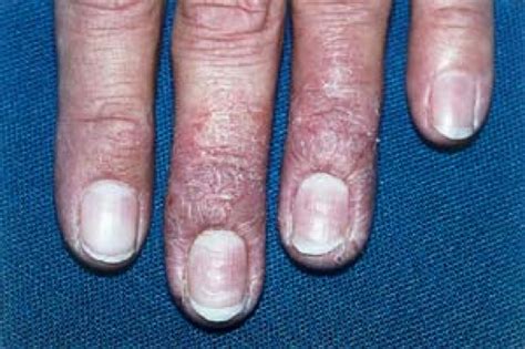 Severe Eczema Of The Nail Nail Ftempo