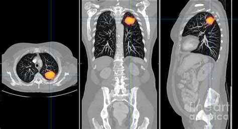 Lung Cancer Ct Scan Photograph By Scott Camazine