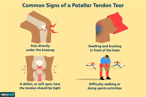 Patellar Tendon Tear Symptoms Causes And Treatment