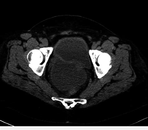 Ct Abdomen And Pelvis Without Contrast Showing Bladder Diverticulum