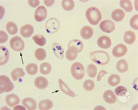 Sickle Cell Anemia Under Microscope Quinton Oyler