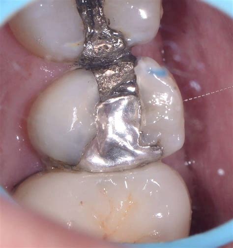 Lithium Disilicate Overlay Using Digital Dentistry Dental Case Of The Day