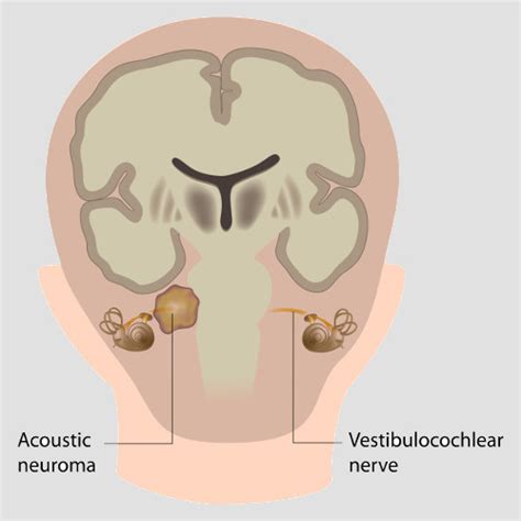 Acoustic Neuroma Healthdirect