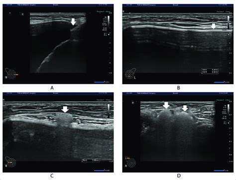 Sonographic Findings On Postoperative Month 3 A The Patient
