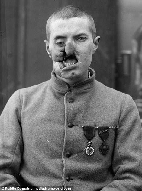 Before And After Photographs Show Wwi Soldiers’ Injuries